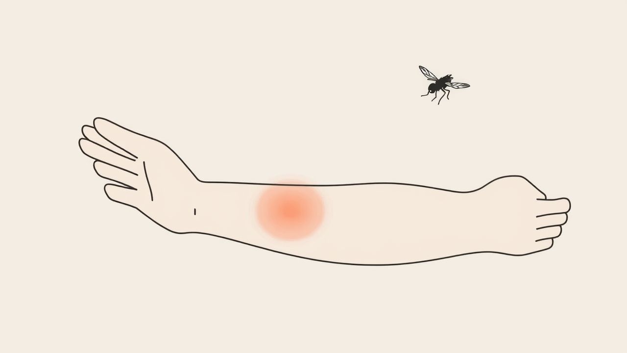 Allergic Reaction to Horsefly Bite