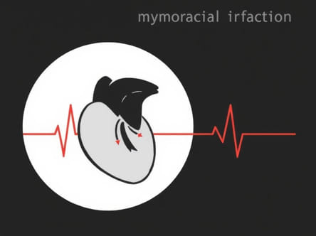 Killip Classification For Myocardial Infarction
