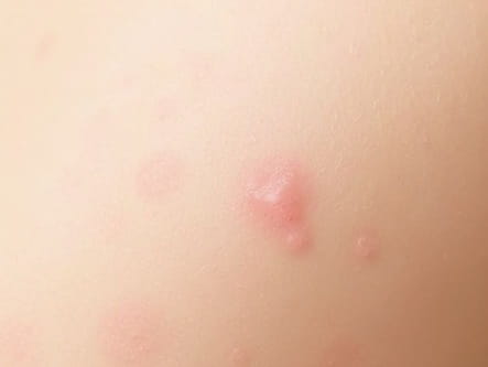 Pustular Psoriasis Also Known As