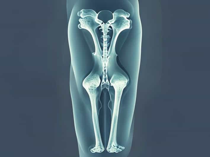 Non-Ossifying Fibroma Knee X Ray