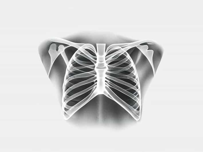 Post Mastectomy Chest X Ray