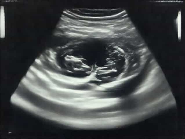 Dilated Seminal Vesicles Ultrasound