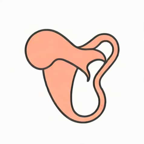 Uterine Apoplexy Is Associated With